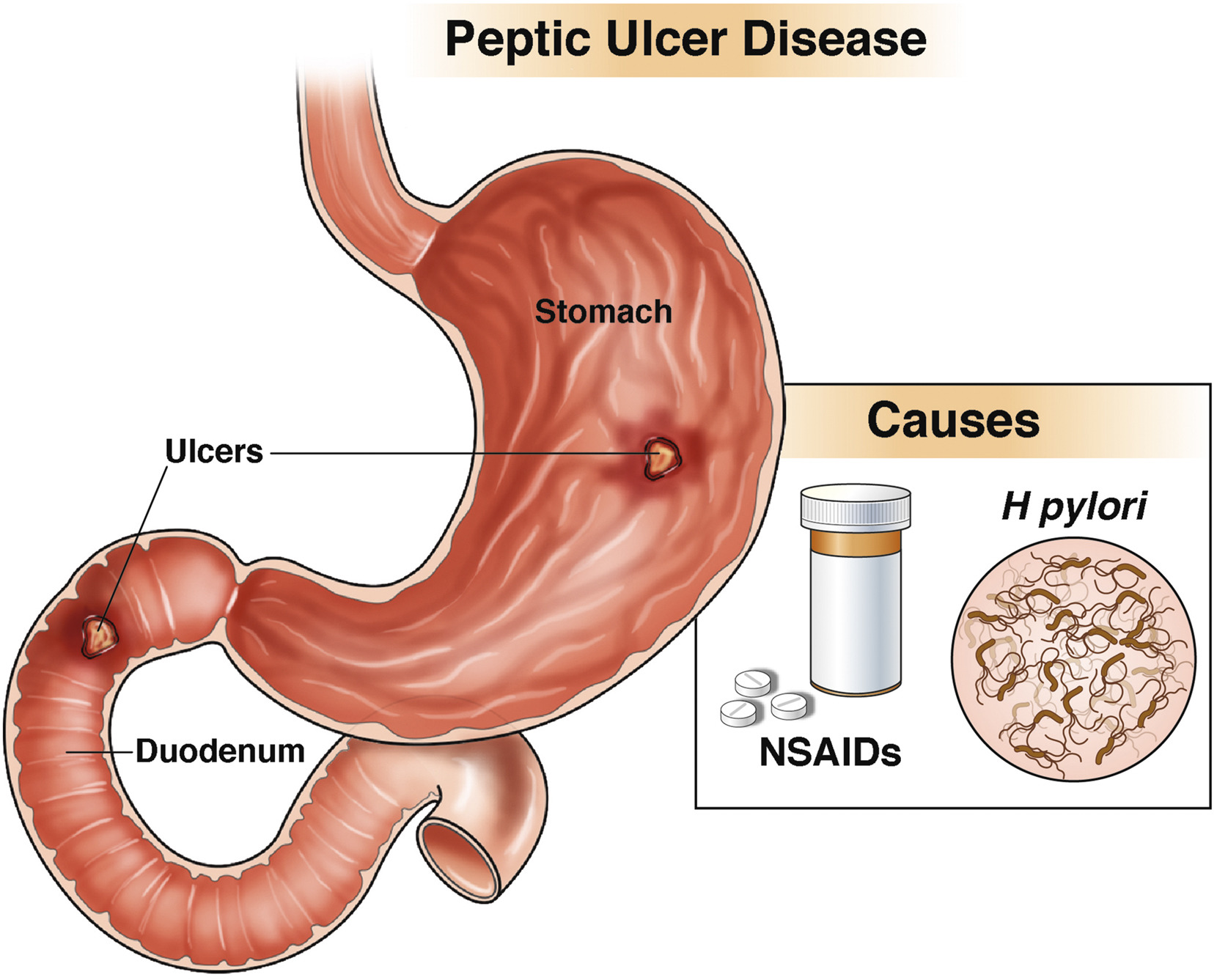 Peptic Ulcer diagram